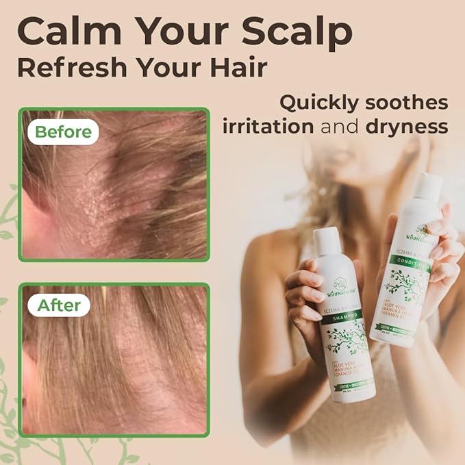 Anti-Dandruff & Seborrheic Dermatitis Treatment Shampoo & Conditioner Set for Men & Women - For Itchy, Dry Scalp and Hair with Psoriasis & Eczema