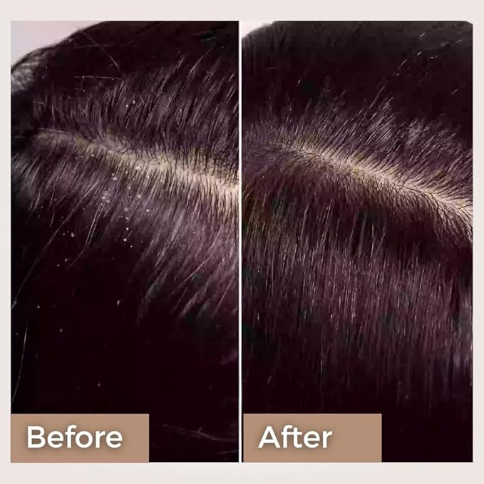 Rosemary Anti Dandruff Hair Oil - Strengthens Hair, Itchy Flakes Scalp, Dandruff Remover with Rosemary, Ginger, Fenugreek, Pippali for Men Women 100 ml Pack of 1 Gold