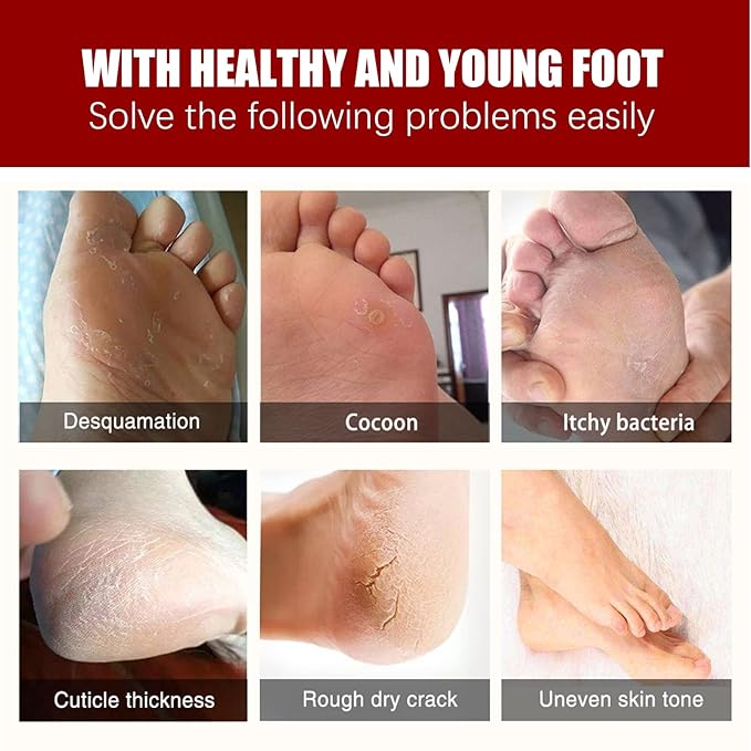 Exfoliating Foot Mask with AHA 30% + BHA 2%, Natural Moisturizing Peeling Solution for Dry Cracked Feet, 1 Pair