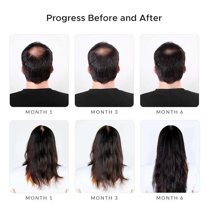 Premium: Shampoo with Minoxidil, Biotin, DHT Blocker (Saw Palmetto) & Caffeine - Activator for Hair Regrowth & Thickening for Men and Women, Anti-Hair Loss