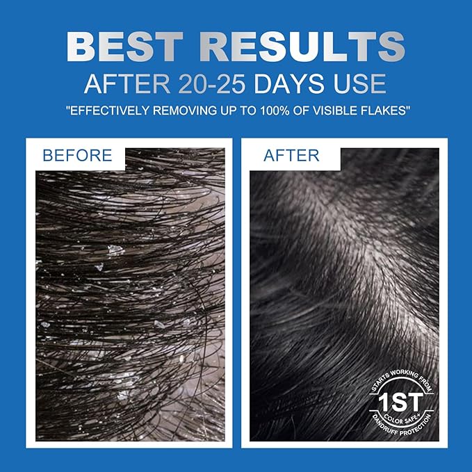 Ceson&Cesun Anti-Fungal/Anti Dandruff 2 in 1 Shampoo for Folliculitis, Scalp Psoriasis & Seborrheic Dermatitis, Itchy & Dry Scalp Relief, Nourishes, Hydrates, Fresh Scent, Safe For Color-Treated Hair