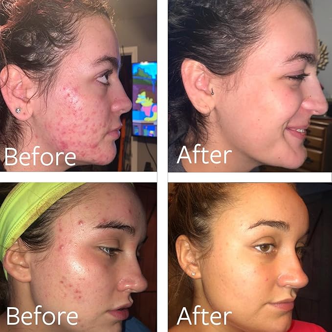 Dr Song Benzoyl Peroxide Wash 10% with Hyaluronic Acid Acne Treatment: Acne Face Wash & Back, Butt, Body Wash Korean Skincare (8oz)