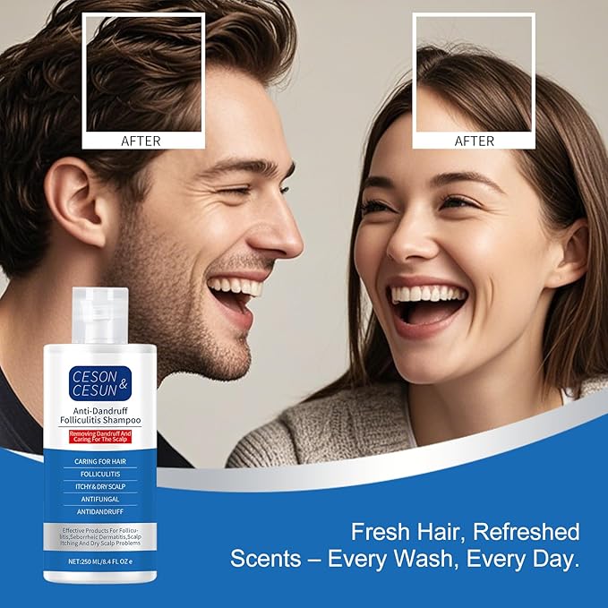 Ceson&Cesun Anti-Fungal/Anti Dandruff 2 in 1 Shampoo for Folliculitis, Scalp Psoriasis & Seborrheic Dermatitis, Itchy & Dry Scalp Relief, Nourishes, Hydrates, Fresh Scent, Safe For Color-Treated Hair