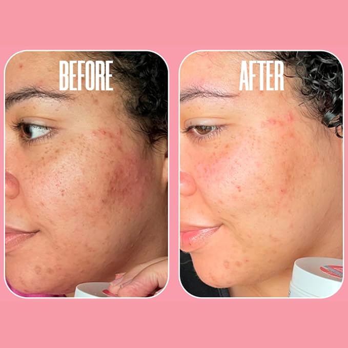 Glycolic Acid Pads with Vitamin C - Toner Pads for Face Cleansing With Tea Tree Oil - Exfoliating Pads with 20% AHA & Vitamins E, B3, B5 - Facial Peel Resurfacing Pads, Glycolic Acid Peel (50)