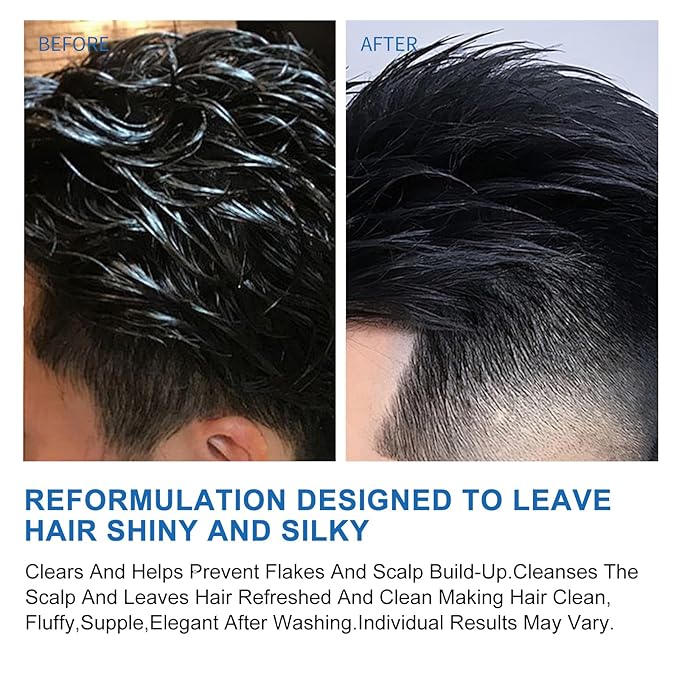 Ceson&Cesun Anti-Fungal/Anti Dandruff 2 in 1 Shampoo for Folliculitis, Scalp Psoriasis & Seborrheic Dermatitis, Itchy & Dry Scalp Relief, Nourishes, Hydrates, Fresh Scent, Safe For Color-Treated Hair