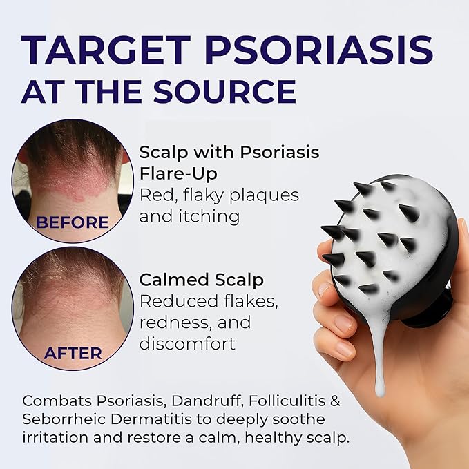 Scalp Psoriasis Shampoo, Flakes Shampoo Anti Dandruff, Itchy Scalp Treatment for Seborrheic Dermatitis & Folliculitis, Anti Fungal, Medicated Solution for Itchy, Flaky & Dry Hairs ( Pack of 2 )