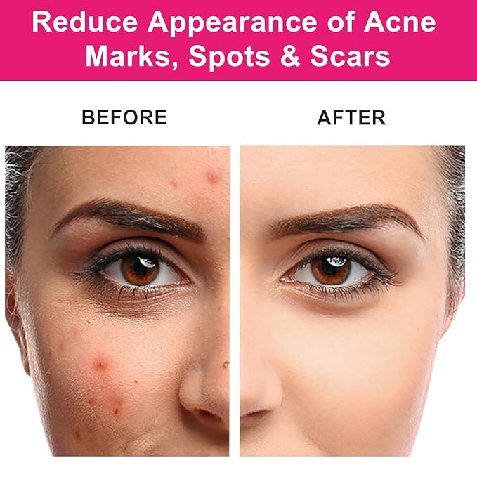 Organic Rosehip Seed Oil for Face, USDA Certified, Cold Pressed, Unrefined, 100% Pure Natural Rose Hip Oil (1oz / 30ml) for Anti-Aging, Acne Scar Treatment, Skin & Hair Care, Gua Sha Massage