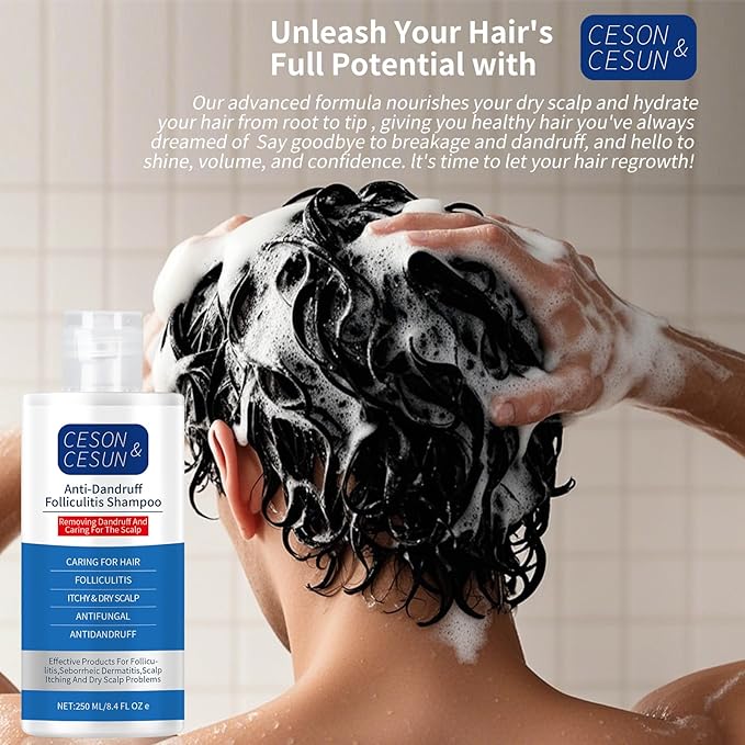 Ceson&Cesun Anti-Fungal/Anti Dandruff 2 in 1 Shampoo for Folliculitis, Scalp Psoriasis & Seborrheic Dermatitis, Itchy & Dry Scalp Relief, Nourishes, Hydrates, Fresh Scent, Safe For Color-Treated Hair
