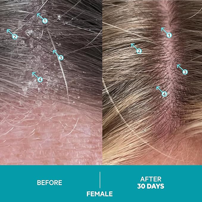 DS Labs Dandrene Dandruff Shampoo - for Flaky, Itchy Scalp, Exfoliating Shampoo for Dry Scalp, Seborrheic Dermatitis, Scalp Psoriasis, Color-Safe, Sulfate-Free, 205mL (Pack of 2)