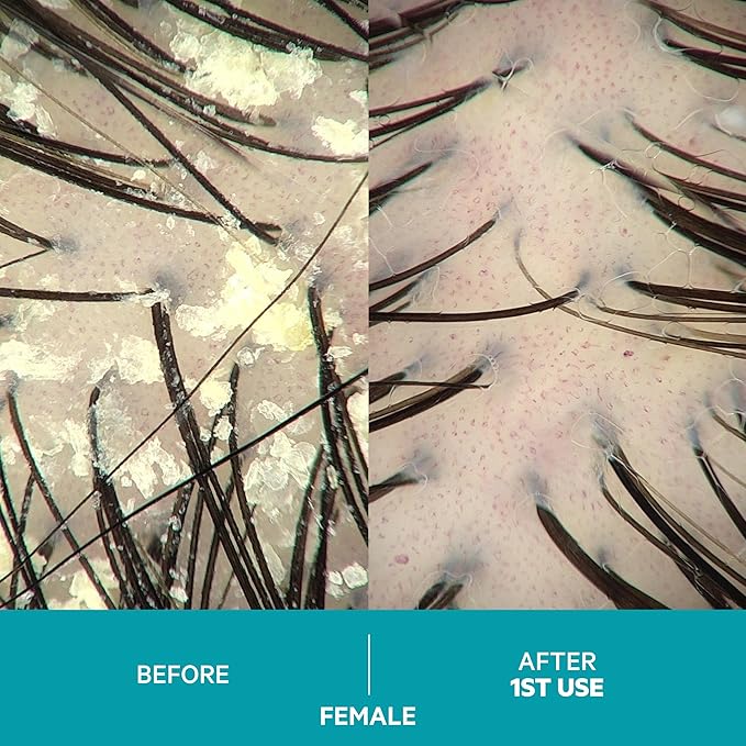 DS Labs Dandrene Dandruff Shampoo - for Flaky, Itchy Scalp, Exfoliating Shampoo for Dry Scalp, Seborrheic Dermatitis, Scalp Psoriasis, Color-Safe, Sulfate-Free, 205mL (Pack of 2)