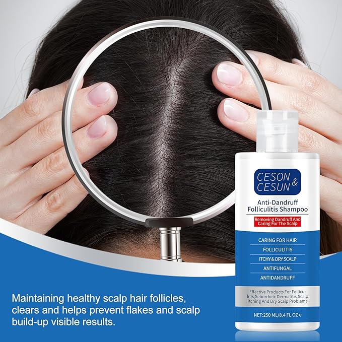 Ceson&Cesun Anti-Fungal/Anti Dandruff 2 in 1 Shampoo for Folliculitis, Scalp Psoriasis & Seborrheic Dermatitis, Itchy & Dry Scalp Relief, Nourishes, Hydrates, Fresh Scent, Safe For Color-Treated Hair