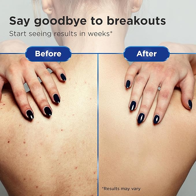 Non-Comedogenic Hair Conditioner by Clear 2 Perfection – Ideal for Acne-Prone Skin, Bacne & Sensitive Scalps – Non Clogging Conditioner