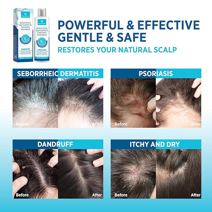 Roycederm Psoriasis Shampoo, Seborrheic Dermatitis Shampoo, Folliculitis, Dandruff, Scalp Psoriasis & Seborrheic Dermatitis Treatment, Dry Itchy Scalp Treatment - 2 Pack