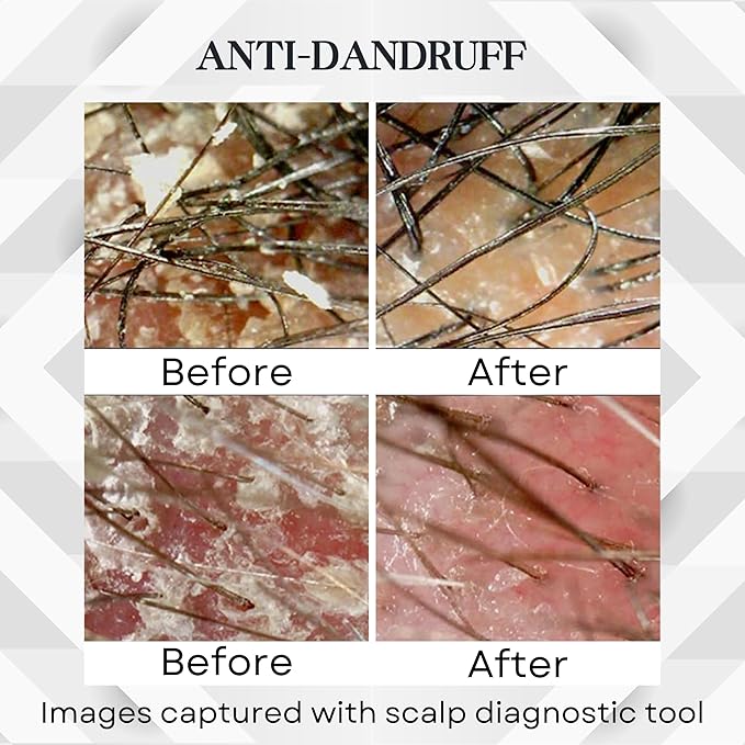 ABERA Amanda Anti-Dandruff Shampoo for Stronger Hair & Healthier Scalp, Nourishes, Get Rid of Dandruff