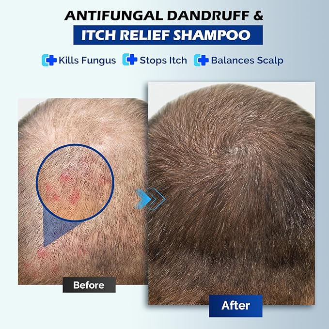 Antifungal Shampoo for Seborrheic Dermatitis, Folliculitis & Scalp Psoriasis, Anti-Dandruff Shampoo for Men & Women, Relieves Scalp Itching, Dryness, Sulfate & Paraben-Free, 10.1 Fl Oz