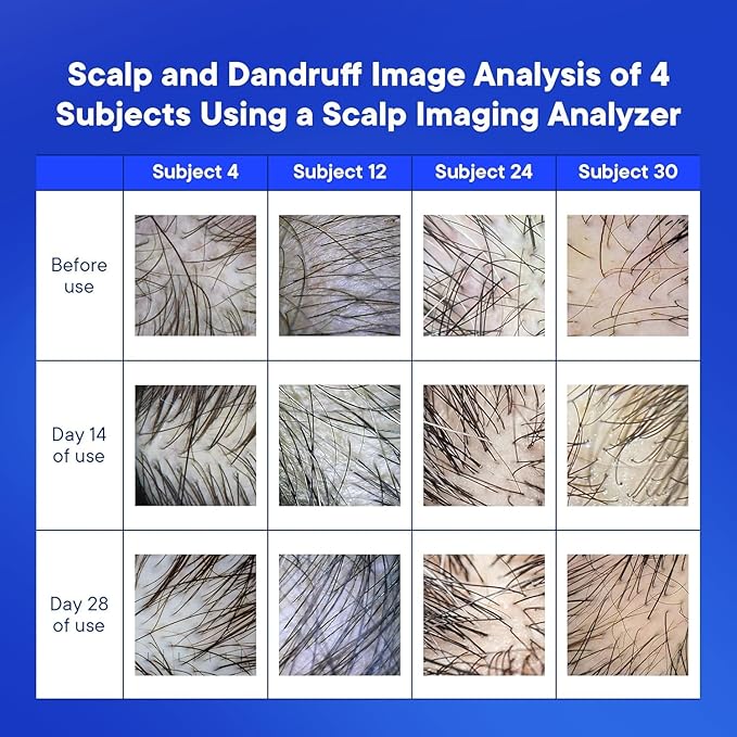 ProBliva Medicated Anti-Fungal & Dandruff Shampoo: Extra Strength Scalp Treatment for Dandruff, Folliculitis, Psoriasis, Seborrheic Dermatitis, Itchy & Dry Scalp