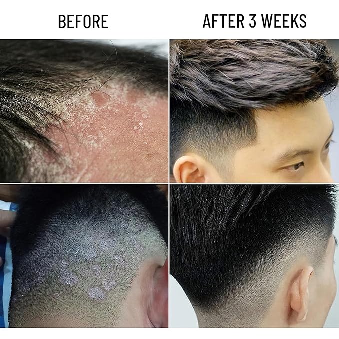 ABERA Amanda Anti-Dandruff Shampoo for Stronger Hair & Healthier Scalp, Nourishes, Get Rid of Dandruff