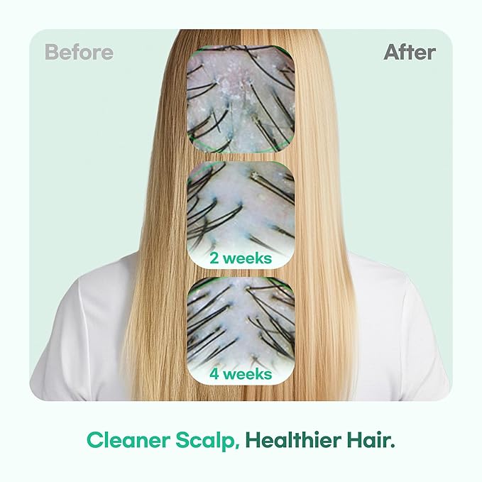 TS GD Shampoo for Teens | Korean Anti-Dandruff for Oily & Itchy Scalp | Fruity Allergy-Free Scent | Sulfate-Free Gentle Hair Care (14.1 Oz) (GD Shampoo for girl)