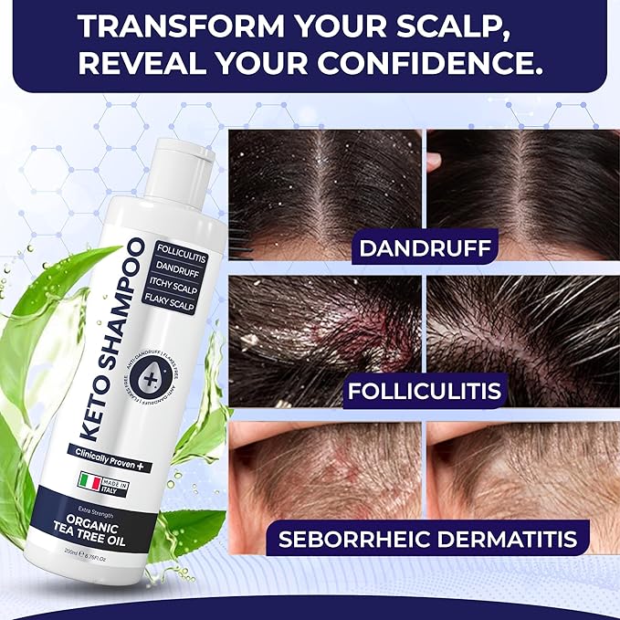 Scalp Psoriasis Shampoo, Flakes Shampoo Anti Dandruff, Itchy Scalp Treatment for Seborrheic Dermatitis & Folliculitis, Anti Fungal, Medicated Solution for Itchy, Flaky & Dry Hairs ( Pack of 2 )