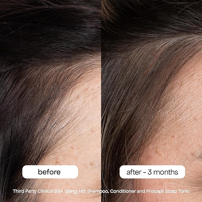 BondiBoost HG Anti-Thinning Shampoo Conditioner Set [10.14 fl oz each], Clinically Tested to Promote Fuller + Thicker-Looking Hair for Women & Men, Procapil, Redensyl & Rosemary Formula, Sulfate-Free