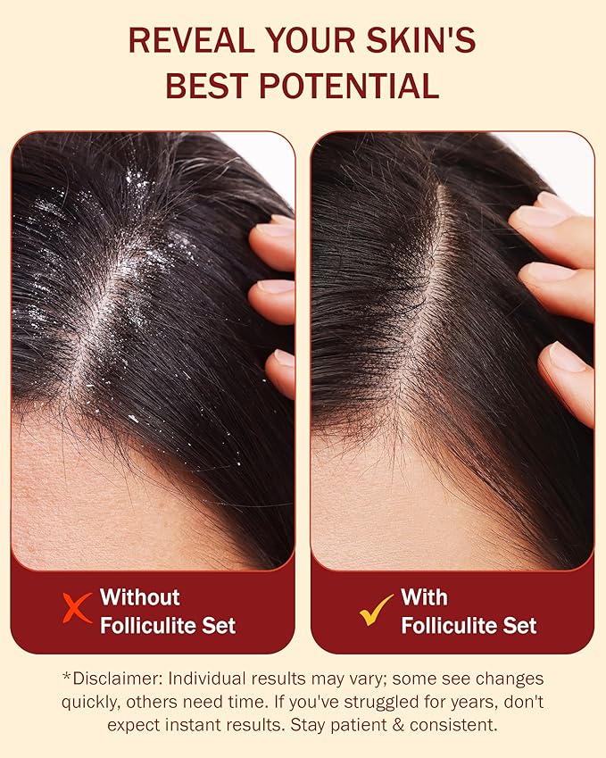 Folliculitis Leave-On Dry Scalp Serum - Non-Greasy Serum for Hair Build-up with Salicylic Acid, Tea Tree Oil & Peppermint Oil - Flaky & Itchy Scalp Care by e70, 2 fl. oz